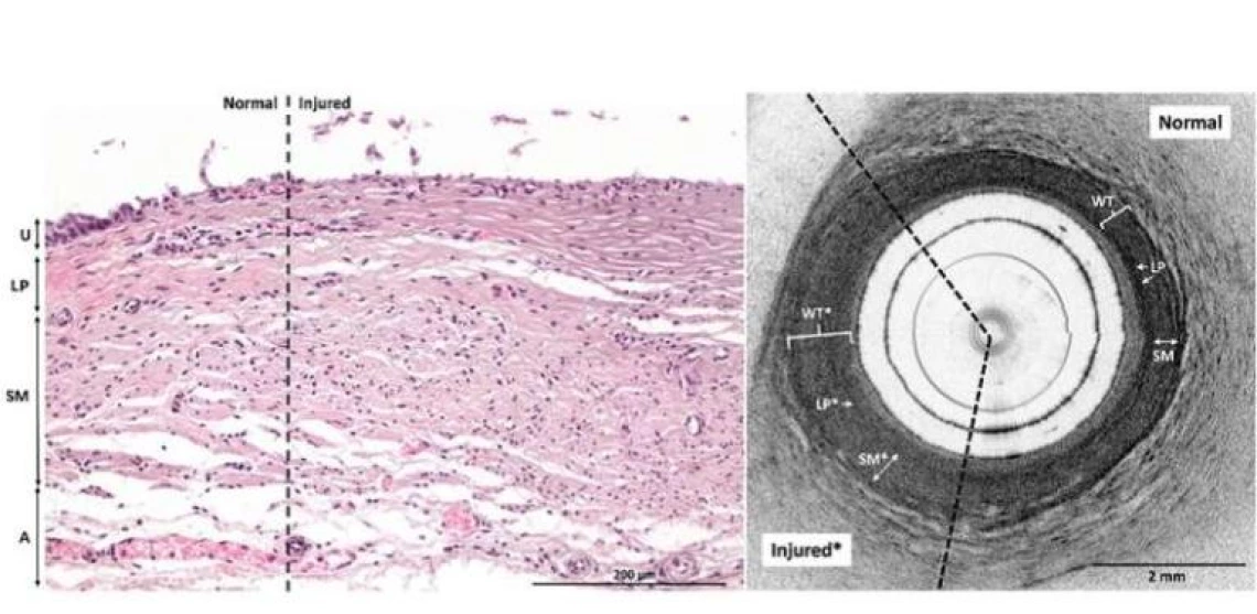 Urethral electrothermal injury shown through optical coherence tomography.